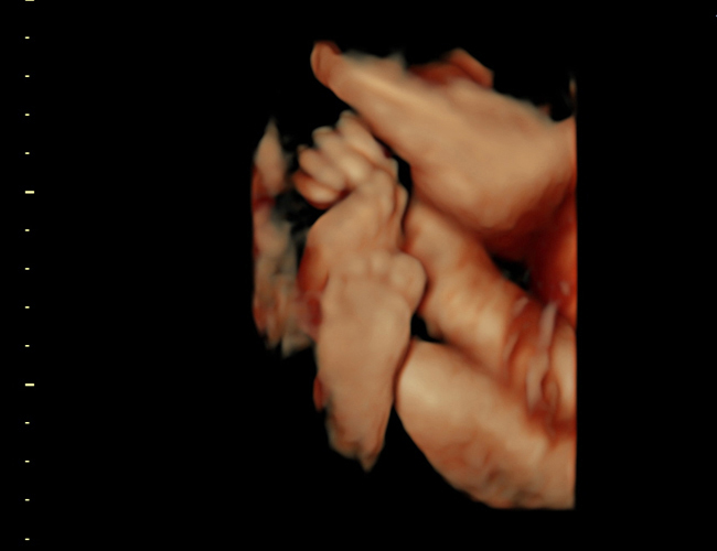 3D ultrasound image at 31 weeks